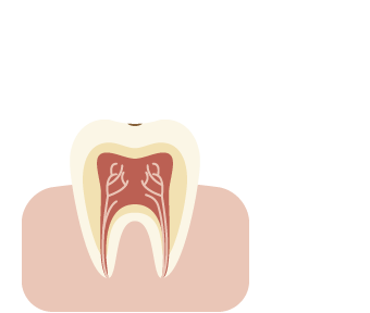 初期のむし歯 イメージ