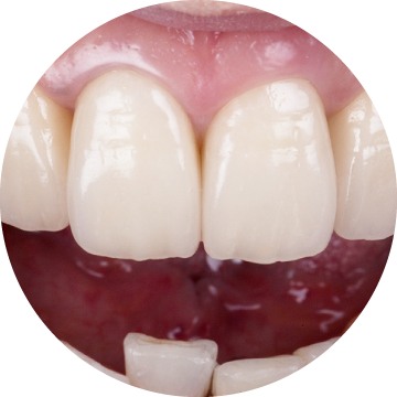 オールセラミック治療を受けた歯